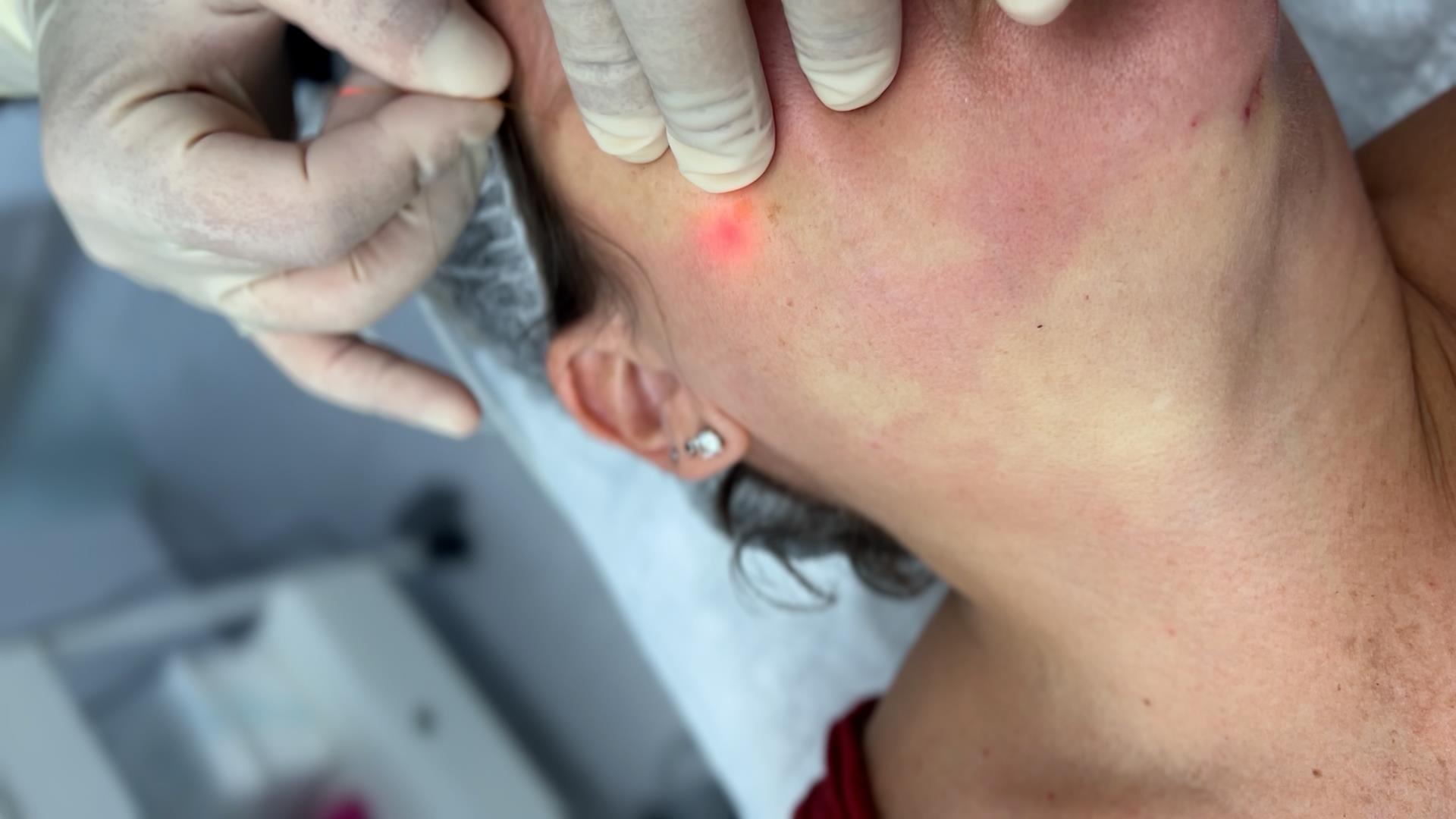 Laser Lift™: Αναίμακτο Λίφτινγκ Προσώπου & Σώματος