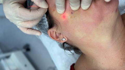 Laser Lift™: Αναίμακτο Λίφτινγκ Προσώπου & Σώματος