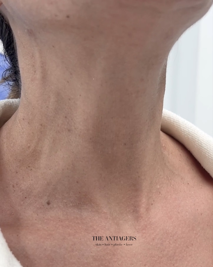 botox neck
