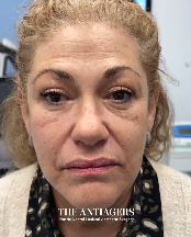 Signature Antigravity Lift™