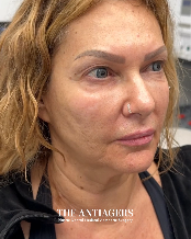 Signature Antigravity Lift™