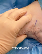 Βραχιονοπλαστική