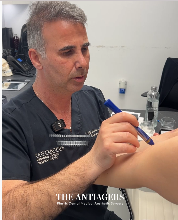 Βραχιονοπλαστική