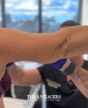 Βραχιονοπλαστική