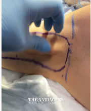 Βραχιονοπλαστική