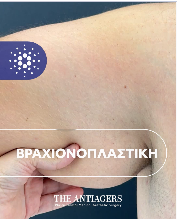 Βραχιονοπλαστική