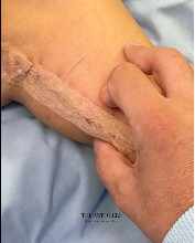 Βραχιονοπλαστική