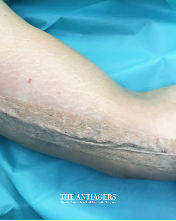 Βραχιονοπλαστική