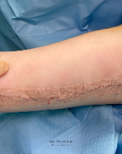 Βραχιονοπλαστική