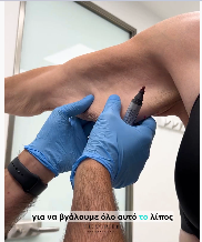 Βραχιονοπλαστική