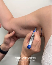 Βραχιονοπλαστική