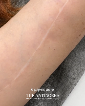 Βραχιονοπλαστική