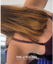 Βραχιονοπλαστική