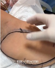 Βραχιονοπλαστική