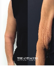 Βραχιονοπλαστική