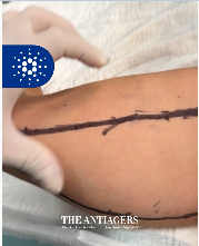 Βραχιονοπλαστική