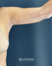 Βραχιονοπλαστική