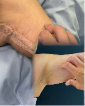 Βραχιονοπλαστική