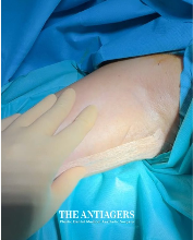 Βραχιονοπλαστική