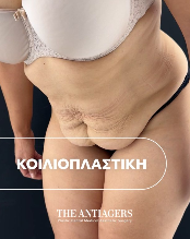 Κοιλιοπλαστική