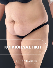 Κοιλιοπλαστική