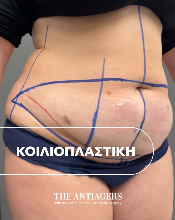 Κοιλιοπλαστική