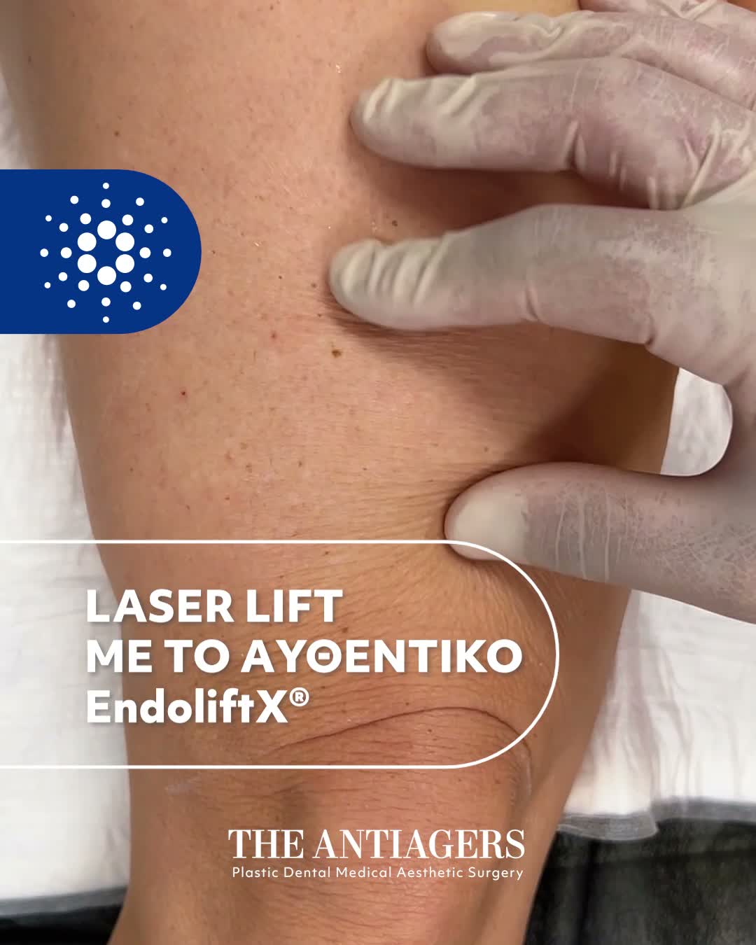 Laser Lift