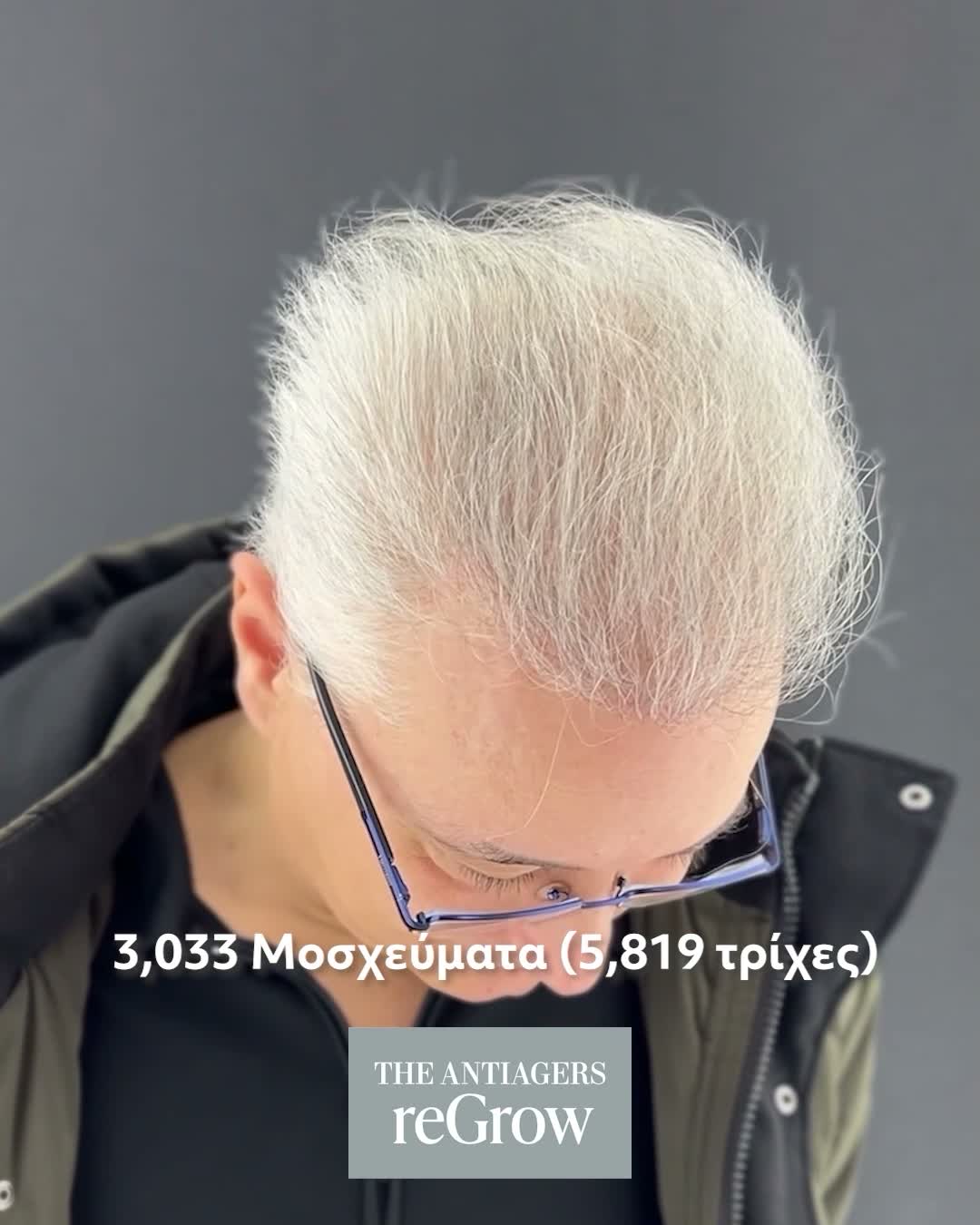 Μεταμόσχευση Μαλλιών
