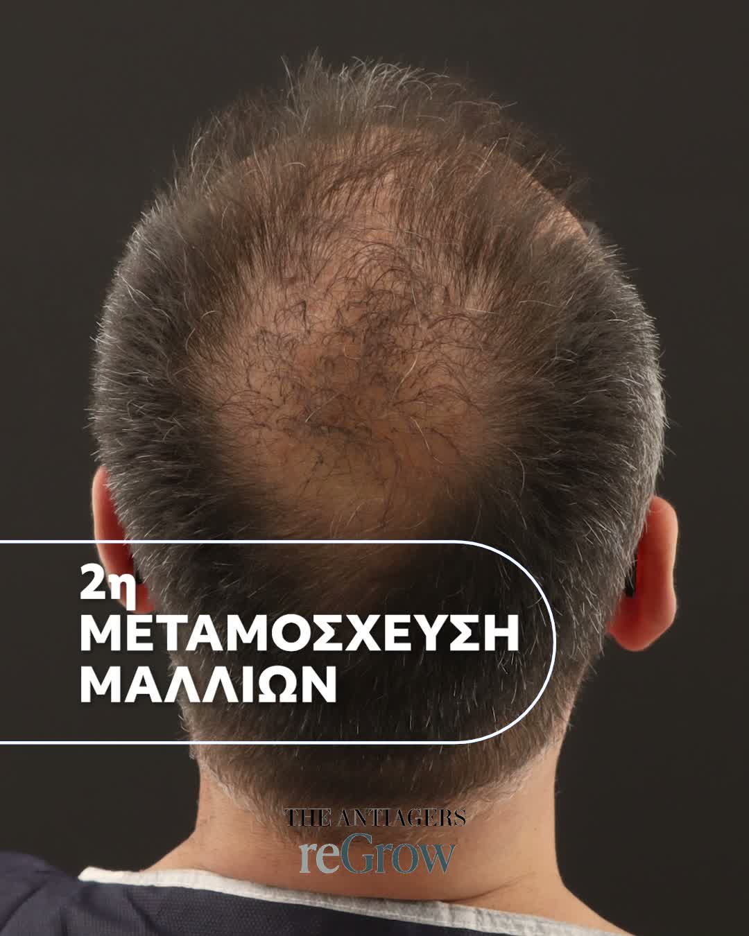 Μεταμόσχευση Μαλλιών