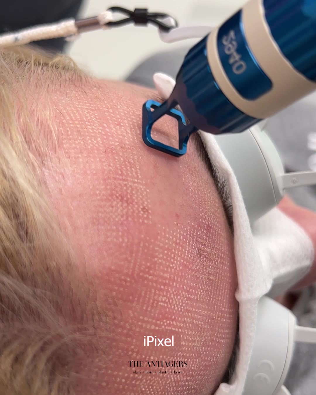 Fractional Laser Προσώπου