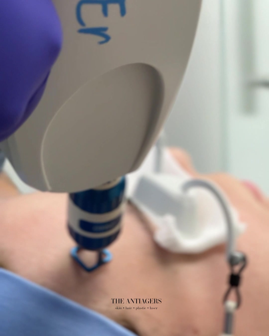 Fractional Laser Προσώπου