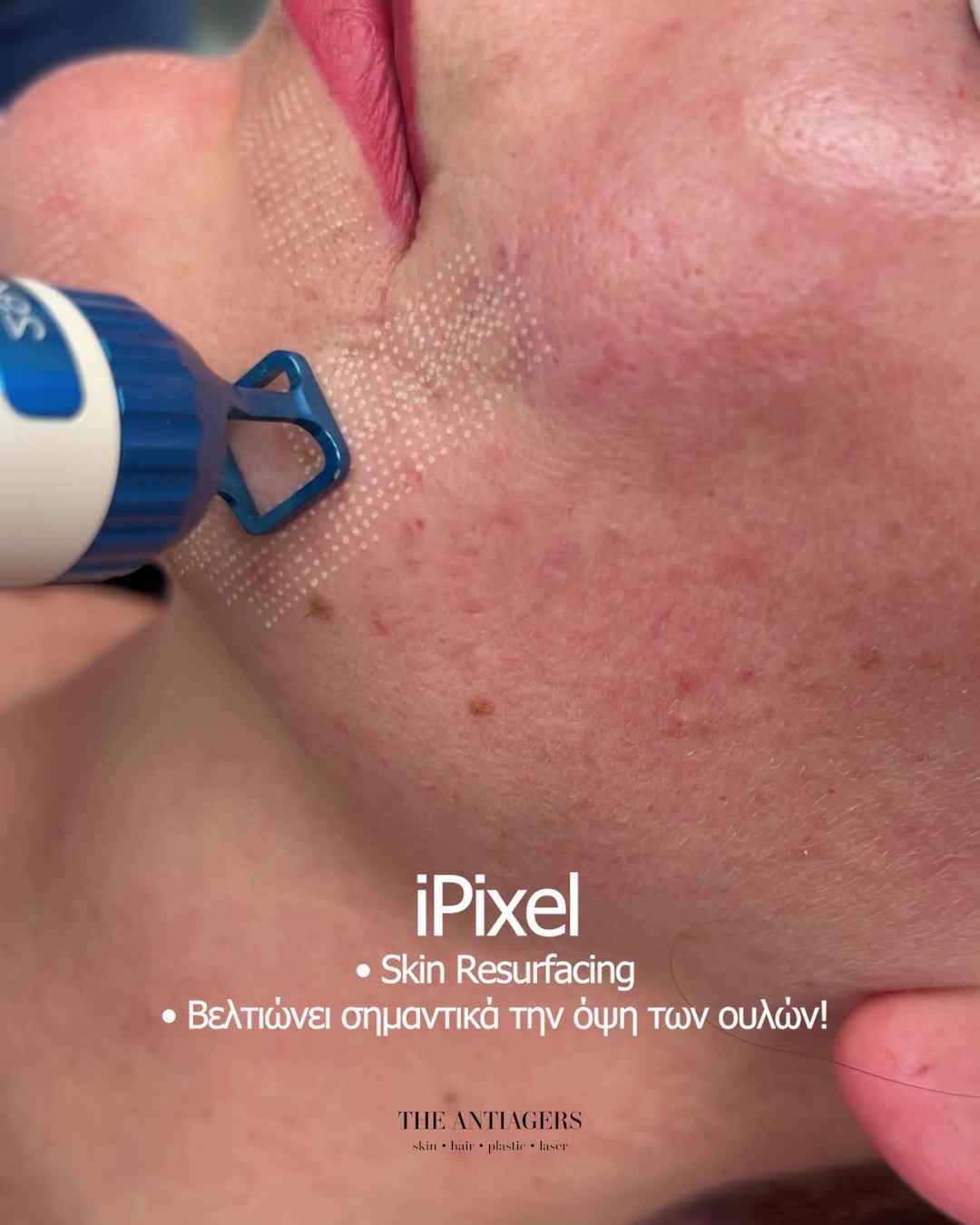 Fractional Laser Προσώπου