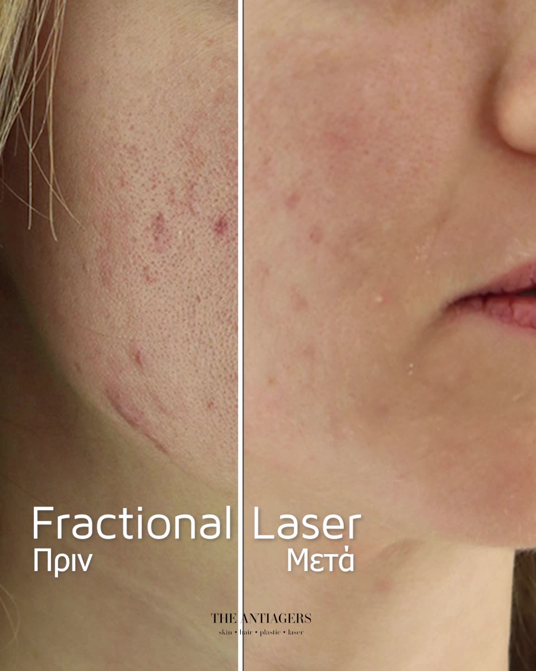 Fractional Laser Προσώπου