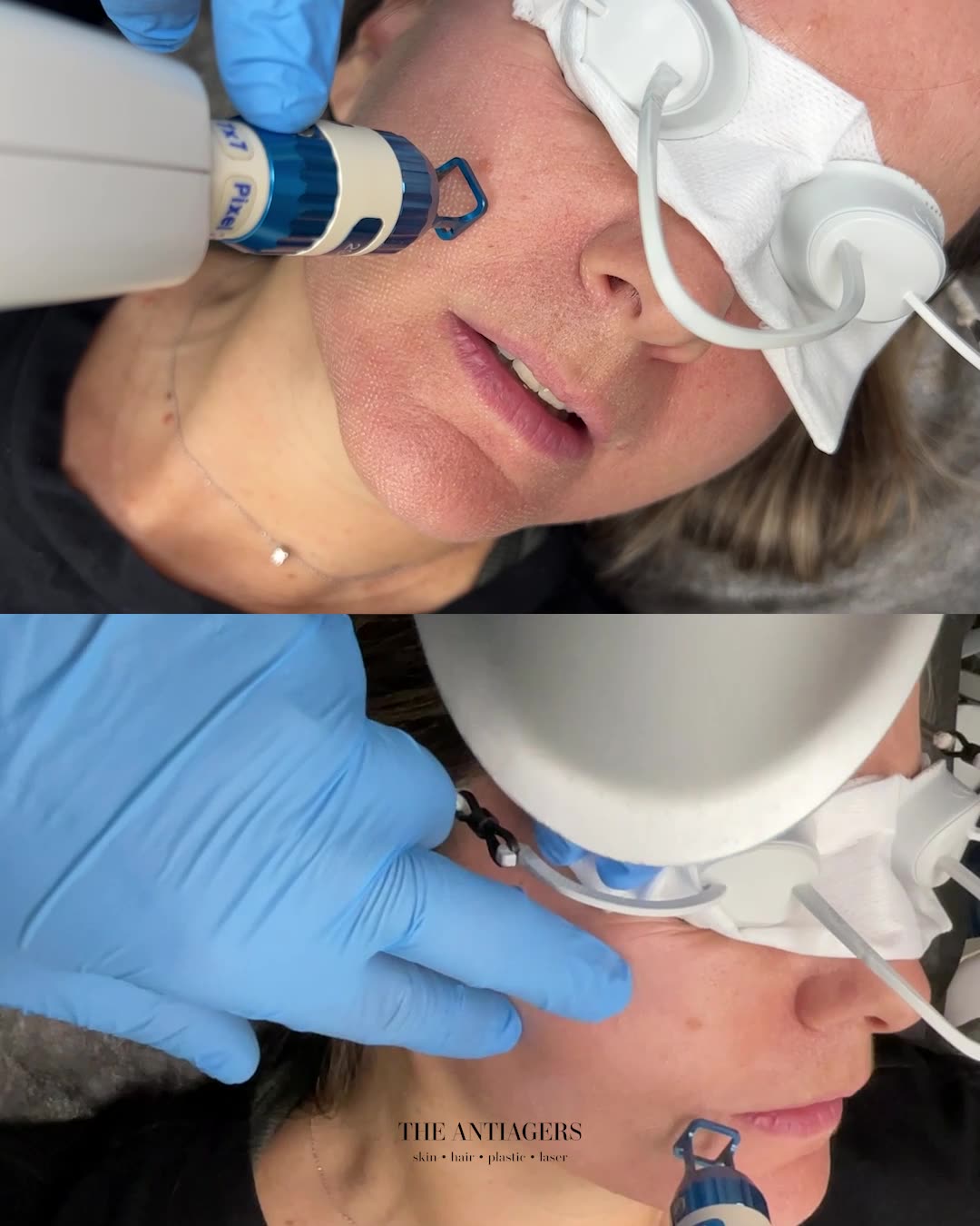 Fractional Laser Προσώπου