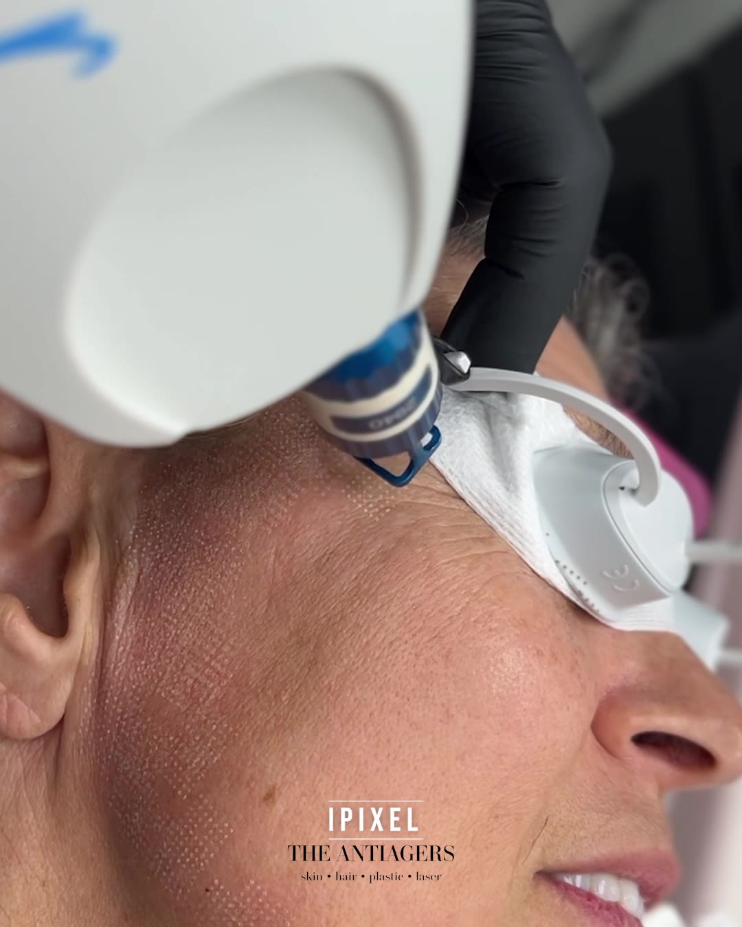 Fractional Laser Προσώπου