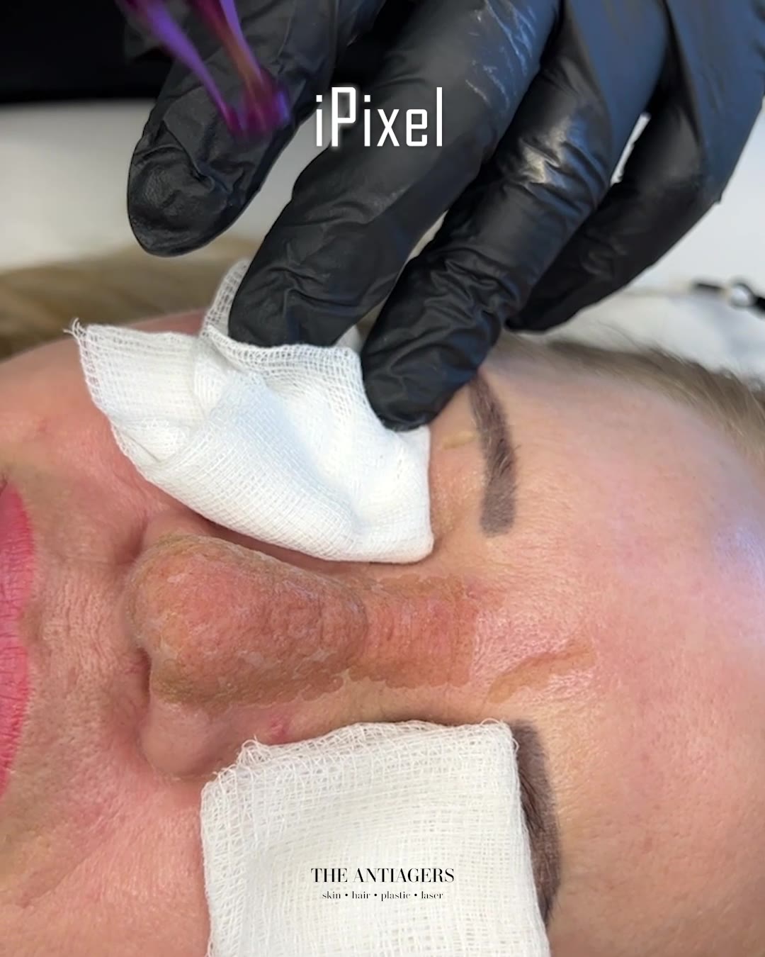 Fractional Laser Προσώπου