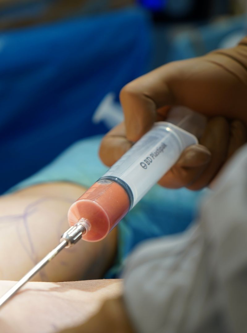 Κοιλιοπλαστική & Λιπομεταφορά (Fat Grafting)