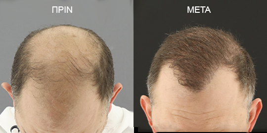 Φωτογραφίες Μεταμόσχευσης Μαλλιών Πριν & Μετά