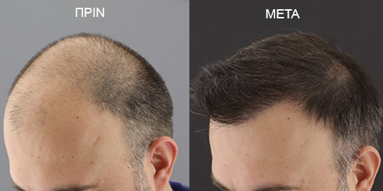 Φωτογραφίες Μεταμόσχευσης Μαλλιών Πριν & Μετά